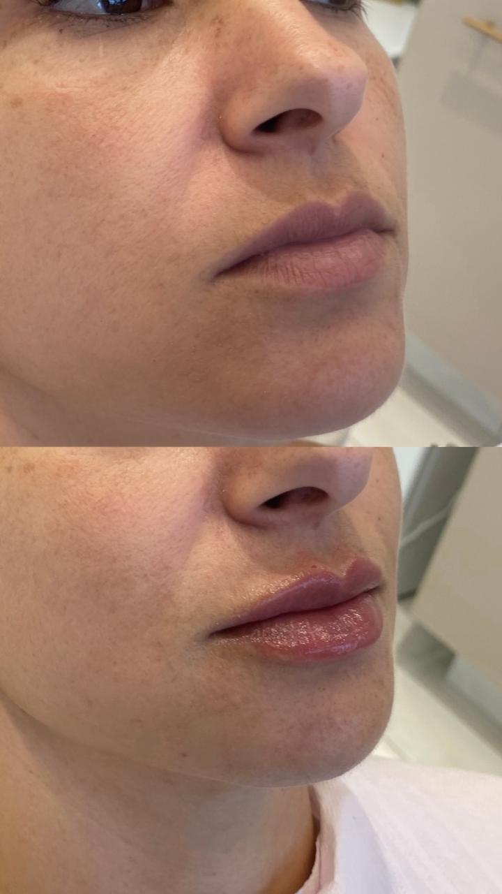 Antes e depois — Preenchimento labial