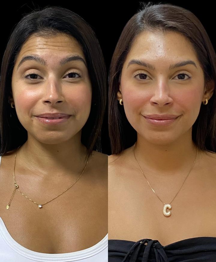 Antes e depois — Toxina botulínica — terço superior