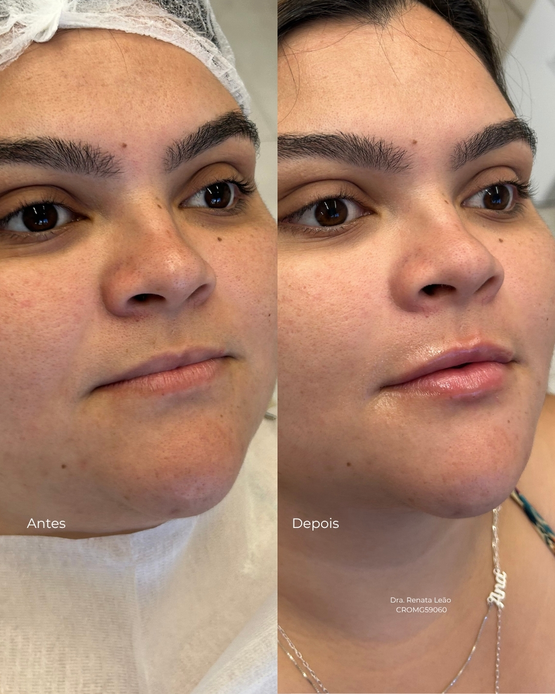 Antes e depois — Preenchimento Labial