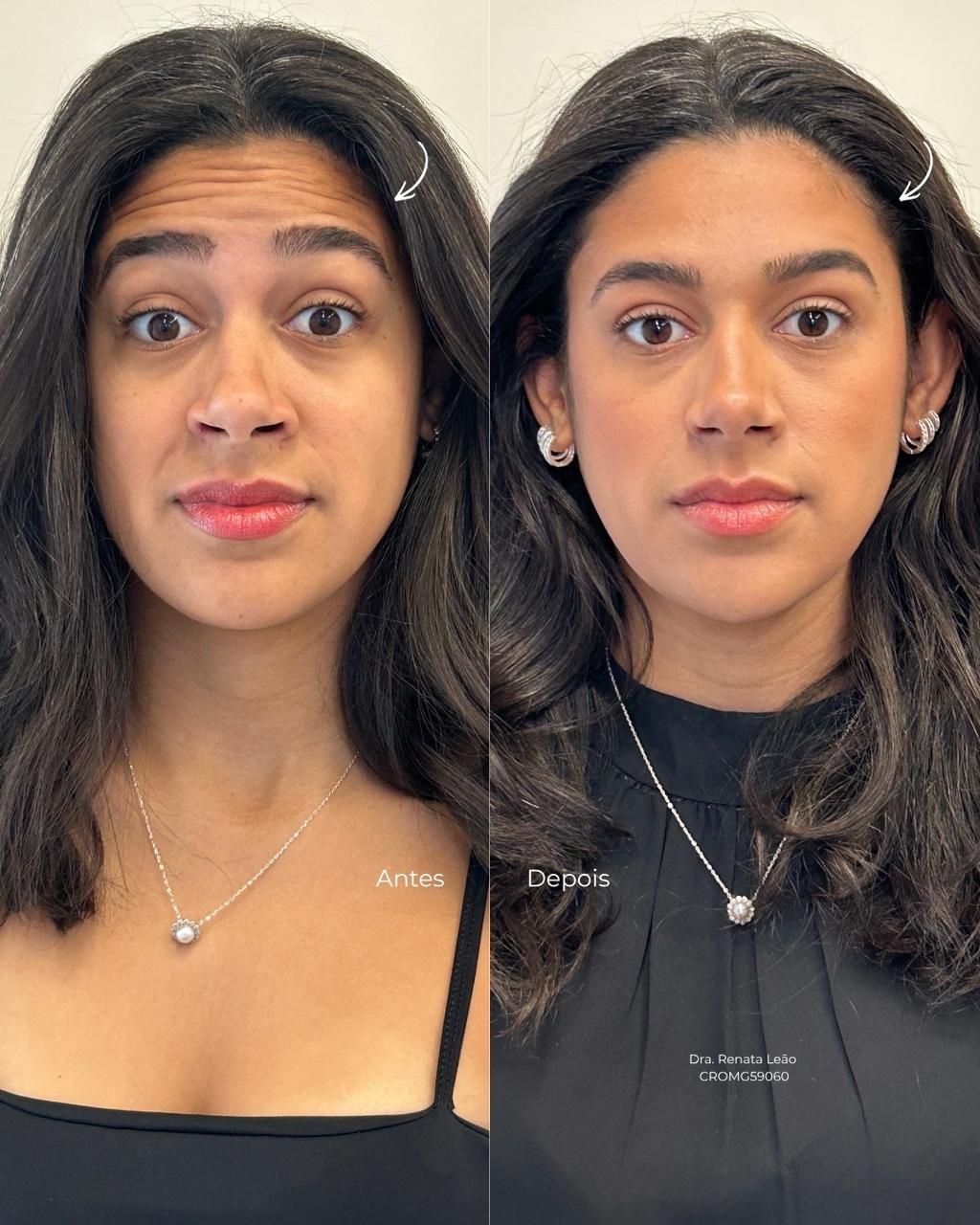 Antes e depois — Toxina botulínica — terço superior