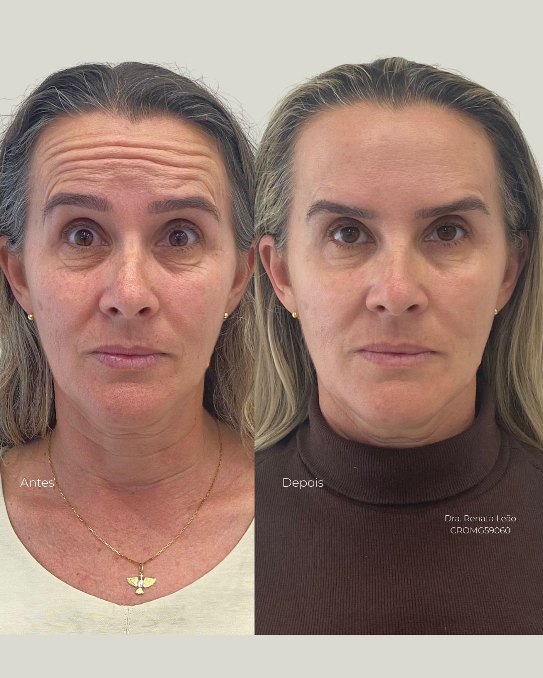 Antes e depois — Toxina botulínica — terço superior